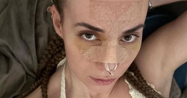 Marianna Schreiber pokazała swój nowy nos w pełnej krasie. Wciąż jest cała posiniaczona