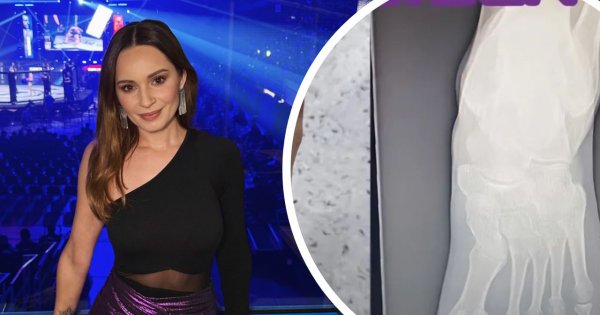 Ewelina Lisowska miała makabryczny wypadek. Zmiażdżyła stopę motocyklem! To zdjęcie rentgenowskie szokuje