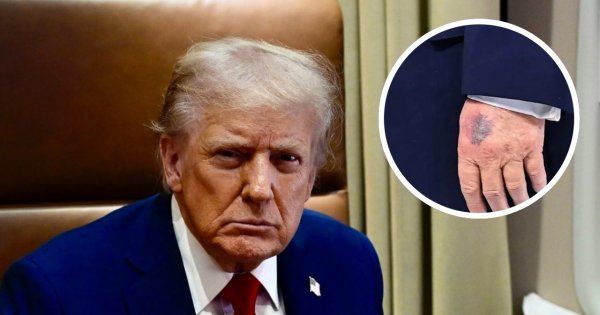 Zaprosił Putina, a potem stało się to. Biały Dom tłumaczy się z nowych siniaków Trumpa