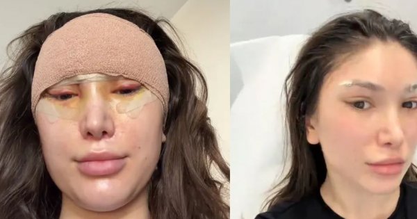 27-letnia Agata Lewandowska zdejmuje szwy po liftingu. "Zrobiło mi się czarno", fani nie gryzą się w język [zdjęcie]