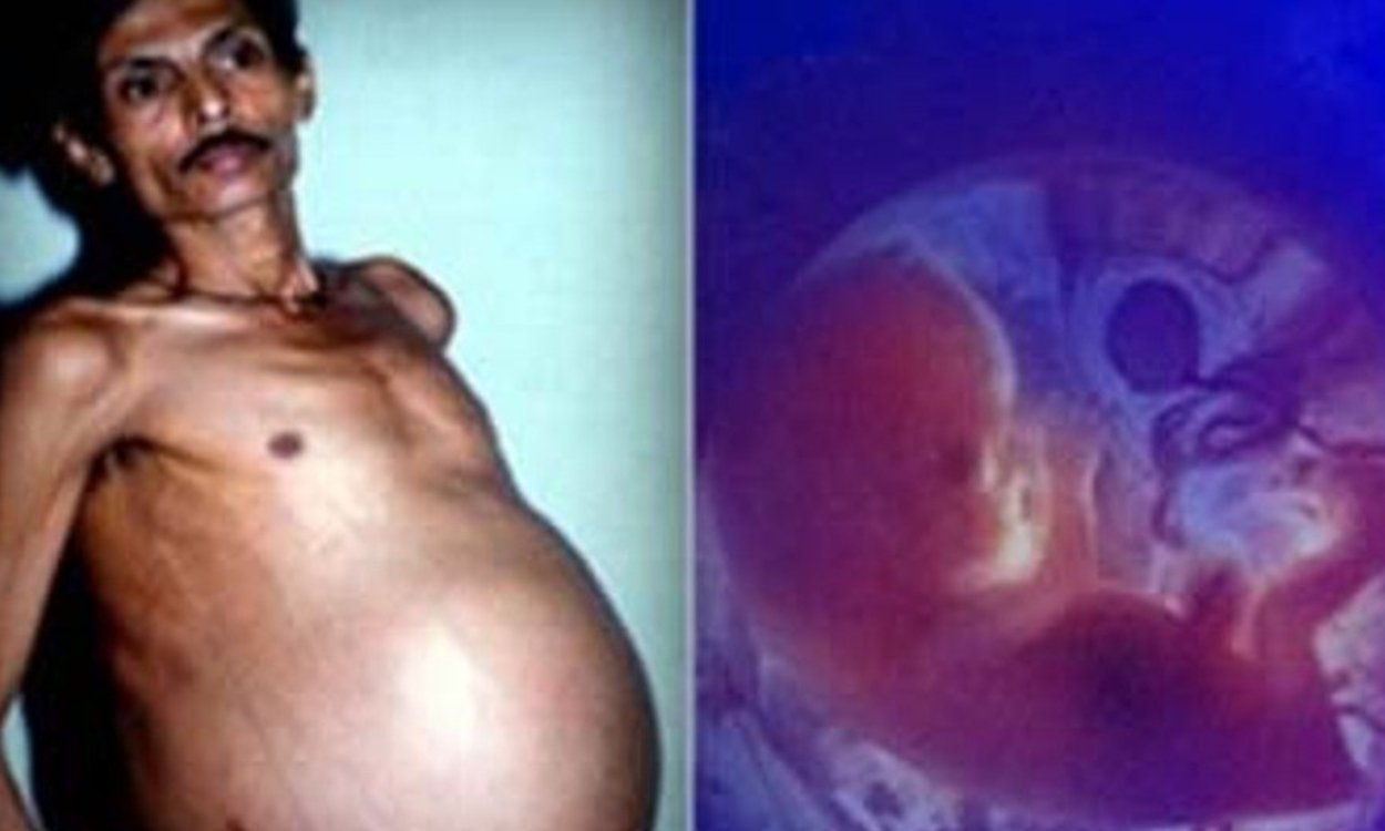 Mężczyzna był 36 lat w ciąży. Wstrząsająca historia, którą udowodniono naukowo