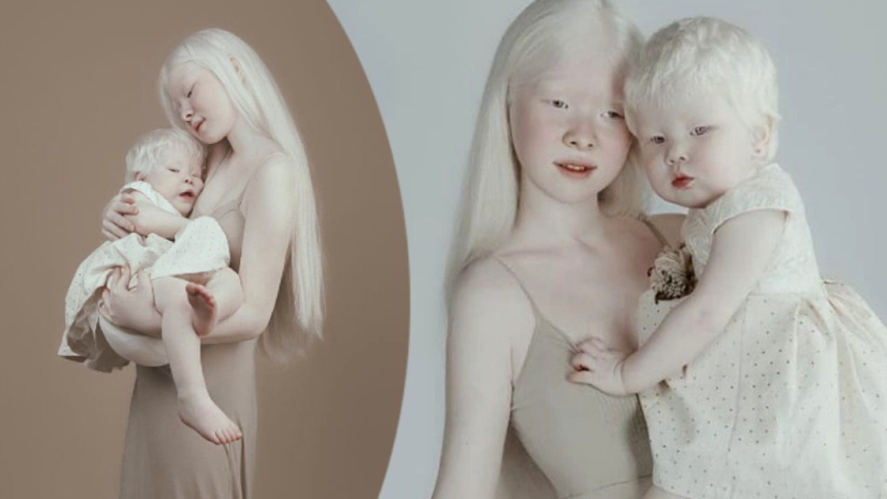 Łączy je siostrzana więź i nietypowa choroba. Dziewczynki z albinizmem oczarowały internautów!