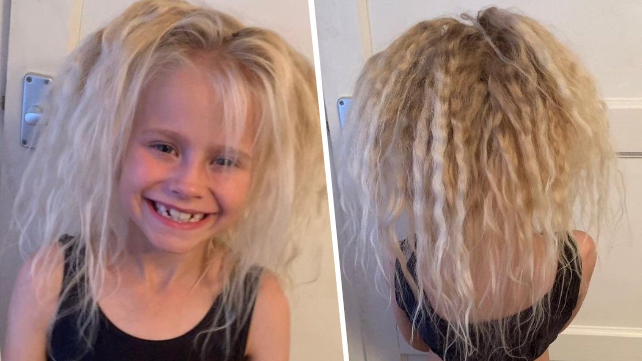 Ta dziewczynka cierpi na zespół włosów niedających się uczesać! Jej fryzura stała się hitem sieci!