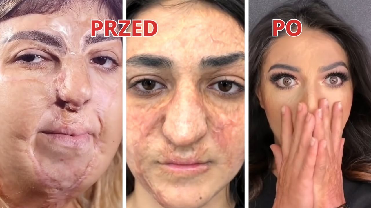 4 kobiety mają całe twarze pokryte bliznami. Zobacz ich oszałamiające metamorfozy makijażowe