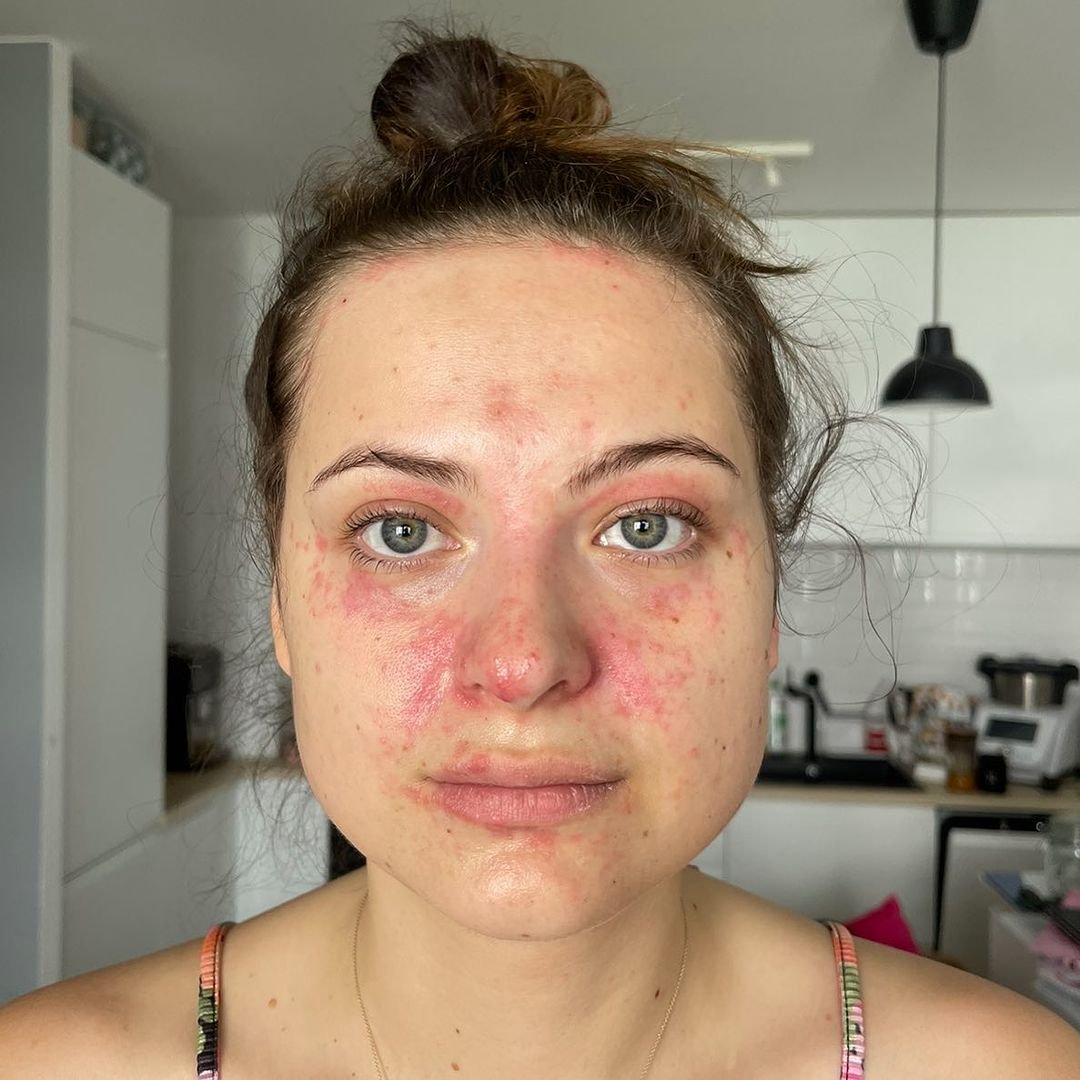Martyna Kaczmarek z silną reakcją alergiczną na twarzy