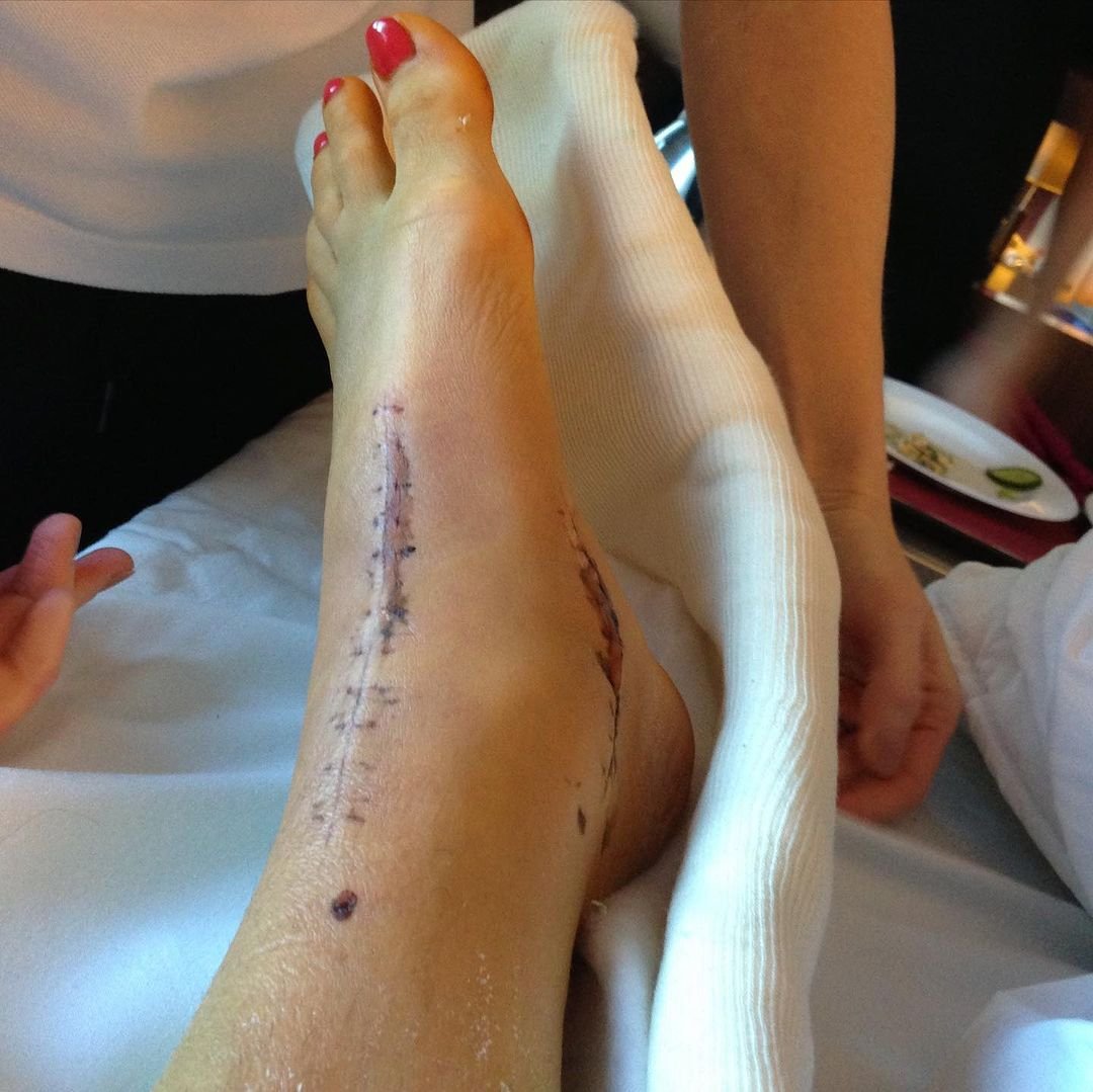 wypadek Weroniki Rosati, poturbowana noga