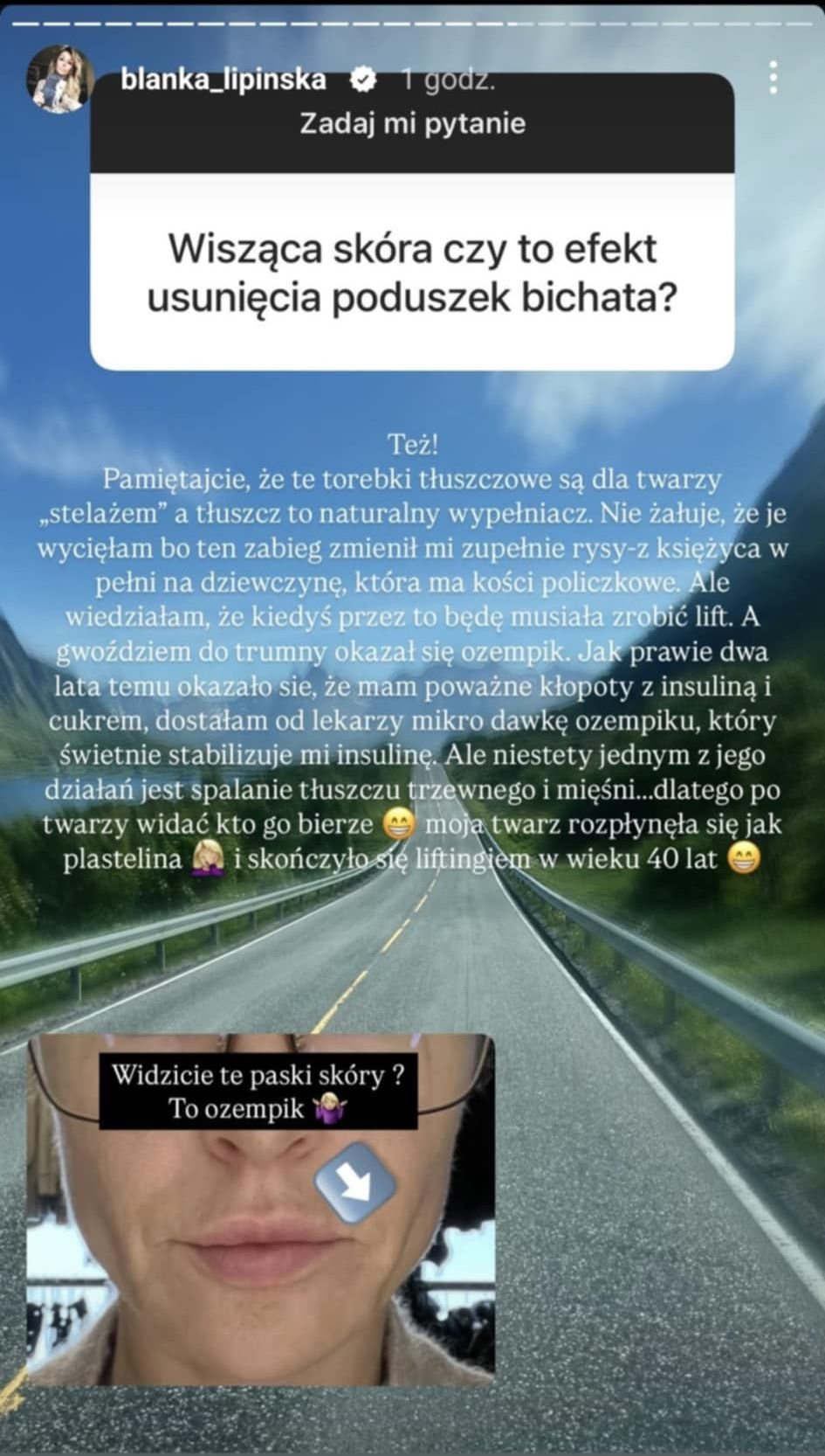 Blanka Lipińska o liftingu twarzy