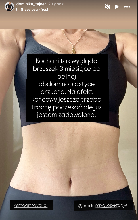 Brzuch Dominiki Tajner po operacji plastycznej brzucha
