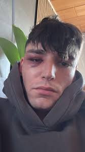 Pascal Kaiser z podbitym okiem robi selfie