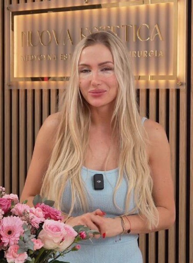 eliza trybała po plastyce powiek