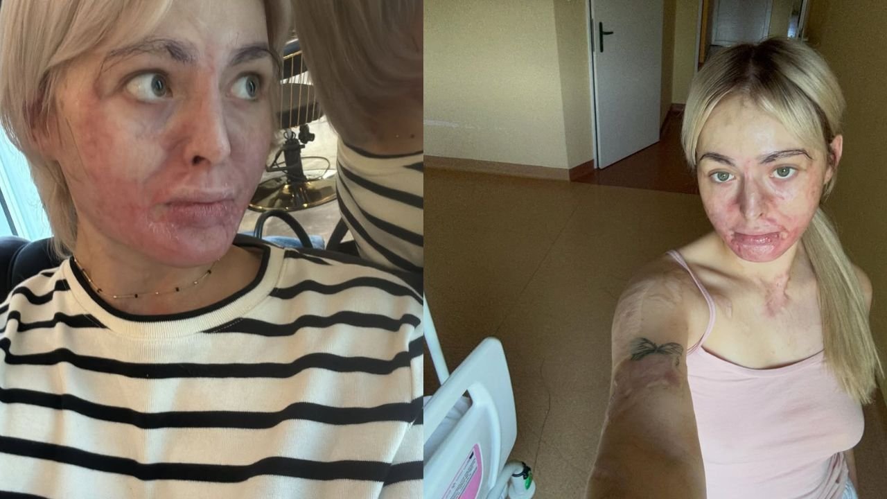 Płonęła żywcem po wybuchu biokominka. Dziś 27-latka w bikini imponuje internautom [zdjęcia]