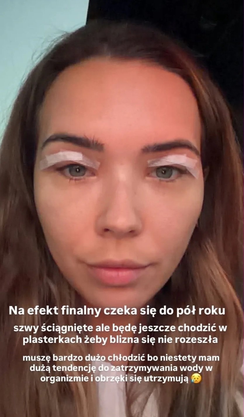 sandra kubicka po zdjęciu szwów na powiekach