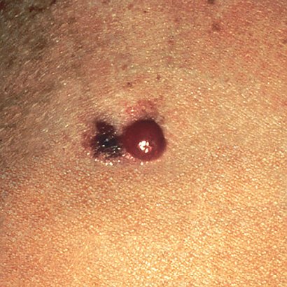 Nowotwór skóry często zaczyna się jako czerwona, łuszcząca się plamka na skórze, która swędzi i krwawi.