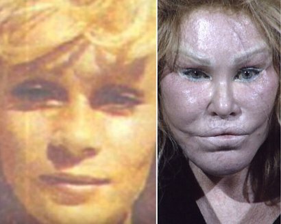 Jocelyn można nazwać chodzącą chirurgią plastyczną: uniosła brwi i powieki, zmieniła część oczu na „kocią”, wszczepiła implanty w policzki i podbródek, zmieniła kształt ust i podniosła środkową część twarzy. Wszystko dla jej byłego męża w 1978 r. Jocelyn, pochodząca ze Szwajcarii , wyszła za mąż za handlarza dziełami sztuki Aleca Wildensteina.