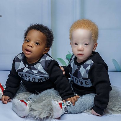 Chłopiec cierpi na albinizm, czyli bielactwo wrodzone.