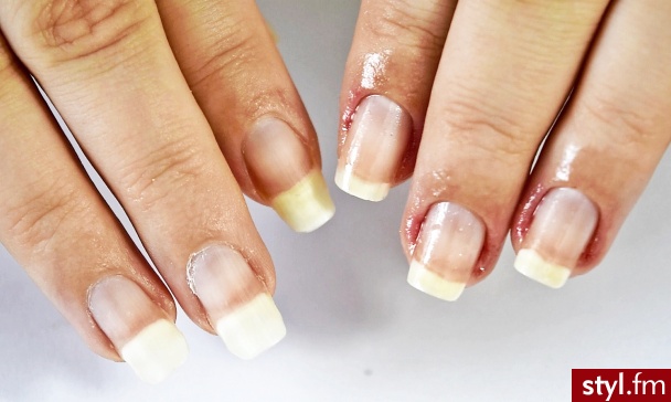 Na zdjęciu efekty przed i po.
DOMOWY MANICURE dla Wrastających i Zrastających się (ze skórą) Paznokci u Rąk FILM NA: https://www.youtube.com/watch?v=6nD9WBFClfM - Kwadratowe Naturalne Paznokcie